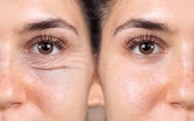 Wrinkle Erase Therapy